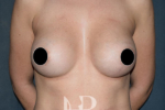 HR Plastic Surgery - Breast Enlargement patient after 1