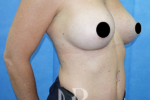 HR Plastic Surgery - Breast Enlargement patient after 10