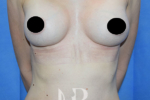 HR Plastic Surgery - Breast Enlargement patient after 12