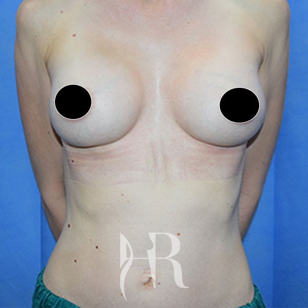 HR Plastic Surgery - Breast Enlargement patient after 12