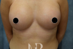 HR Plastic Surgery - Breast Enlargement patient after 13