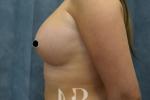 HR Plastic Surgery - Breast Enlargement patient after 15