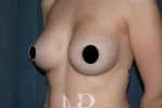 HR Plastic Surgery - Breast Enlargement patient after 2