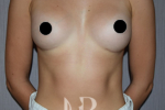 HR Plastic Surgery - Breast Enlargement patient after 4