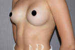 HR Plastic Surgery - Breast Enlargement patient after 5