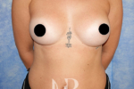 HR Plastic Surgery - Breast Enlargement patient after 6