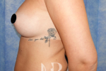 HR Plastic Surgery - Breast Enlargement patient after 8
