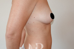 HR Plastic Surgery - Breast Enlargement patient before 11