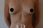 HR Plastic Surgery - Breast Enlargement patient before 12