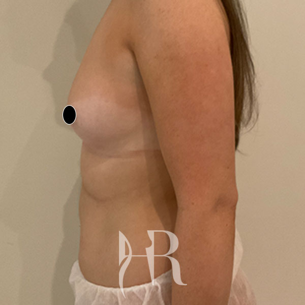 HR Plastic Surgery - Breast Enlargement patient before 15