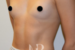 HR Plastic Surgery - Breast Enlargement patient before 5