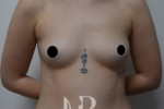 HR Plastic Surgery - Breast Enlargement patient before 6