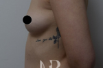HR Plastic Surgery - Breast Enlargement patient before 8
