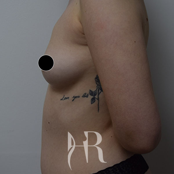 HR Plastic Surgery - Breast Enlargement patient before 8