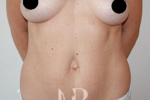 HR Plastic Surgery - Breast Enlargement patient before 9