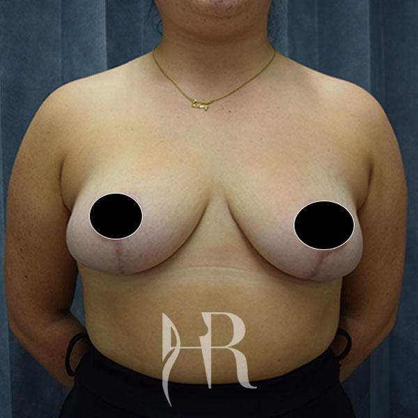 after Breast Reduction surgery