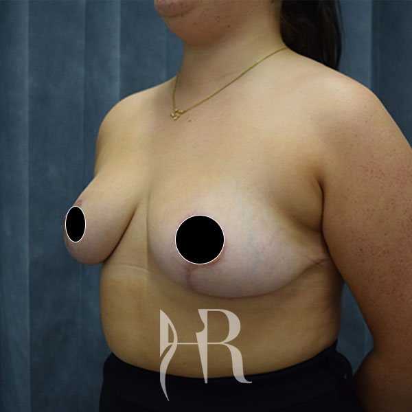 Breast Reduction patient after surgery
