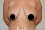 before breast reduction surgery