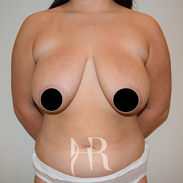 before breast reduction surgery