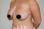 Breast Reduction patient before surgery