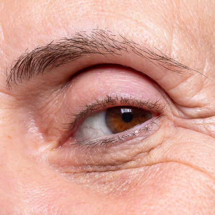 Droopy eye brows treatment