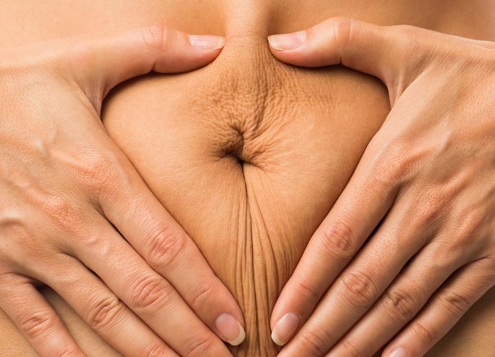 HR Plastic Sugery - Excess - loose abdominal skin