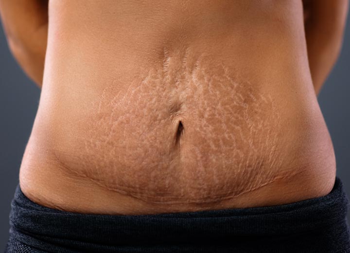 Tummy tuck stretch marks