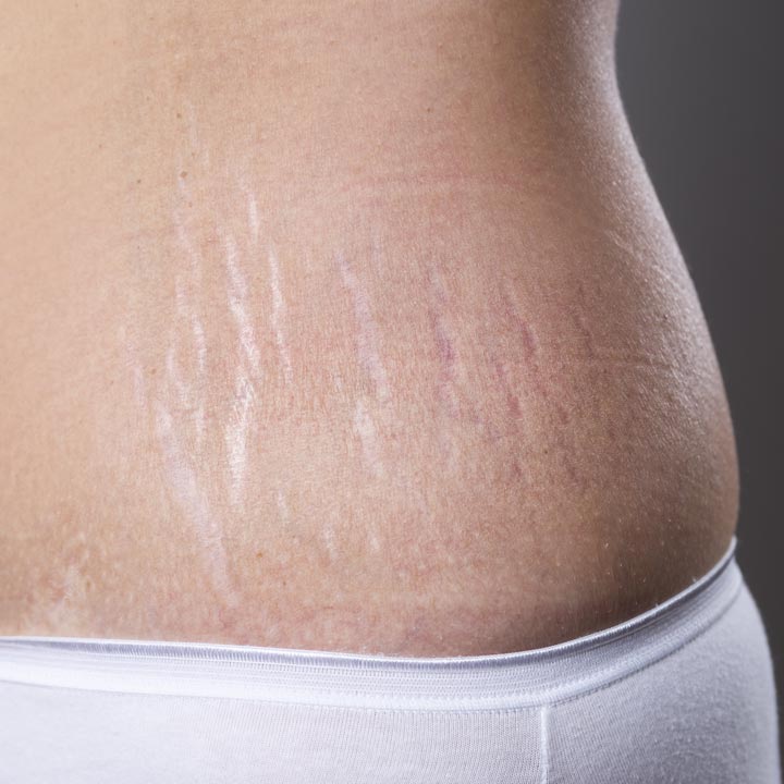 Stretch Marks on Tummy