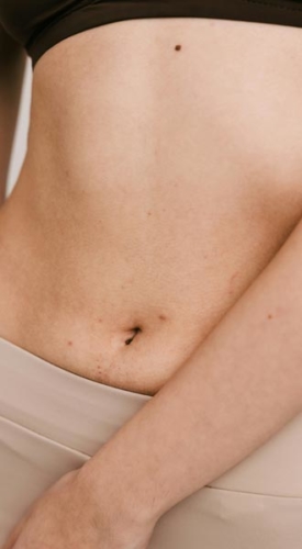 Tummy Tuck Good Candidate
