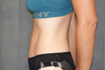 HR Plastic Surgery - Tummy Tuck patient after 13