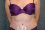 HR Plastic Surgery - Tummy Tuck patient after 14