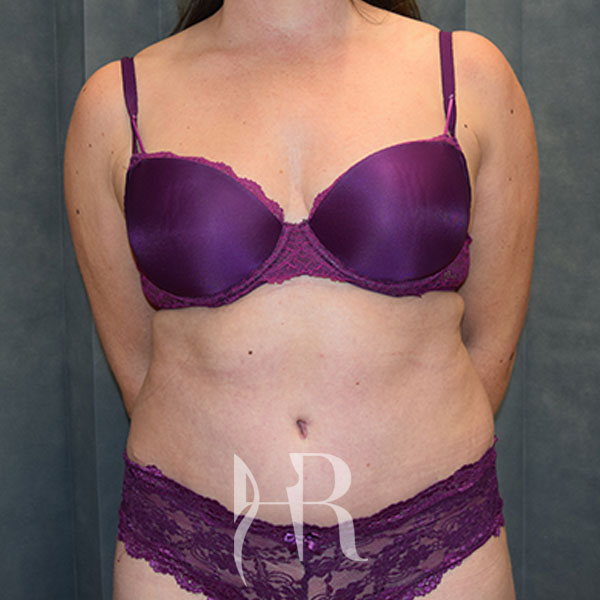 HR Plastic Surgery - Tummy Tuck patient after 14