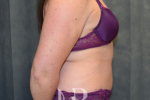 HR Plastic Surgery - Tummy Tuck patient after 15