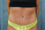 HR Plastic Surgery - Tummy Tuck patient after 19