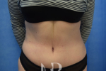 HR Plastic Surgery - Tummy Tuck patient after 22