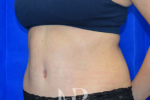 HR Plastic Surgery - Tummy Tuck patient after 24