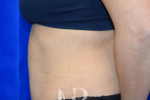 HR Plastic Surgery - Tummy Tuck patient after 25