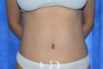 HR Plastic Surgery - Tummy Tuck patient after 26