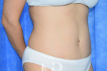 HR Plastic Surgery - Tummy Tuck patient after 27