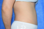HR Plastic Surgery - Tummy Tuck patient after 28