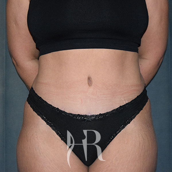 HR Plastic Surgery - Tummy Tuck patient after 6