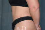 HR Plastic Surgery - Tummy Tuck patient after 8