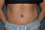 HR Plastic Surgery - Tummy Tuck patient after 9