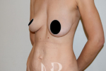 HR Plastic Surgery - Tummy Tuck patient before 12