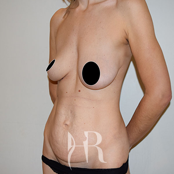 HR Plastic Surgery - Tummy Tuck patient before 12