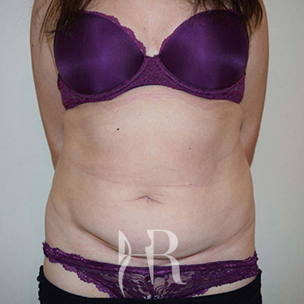 HR Plastic Surgery - Tummy Tuck patient before 14