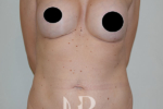 HR Plastic Surgery - Tummy Tuck patient before 19
