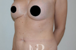 HR Plastic Surgery - Tummy Tuck patient before 20