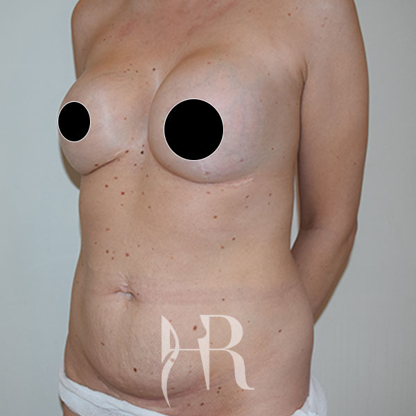 HR Plastic Surgery - Tummy Tuck patient before 20