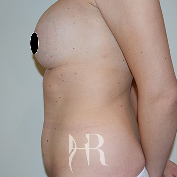 HR Plastic Surgery - Tummy Tuck patient before 21
